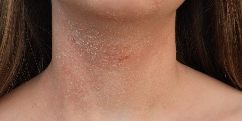 Вопросы противозудной терапии на фоне ксероза кожи