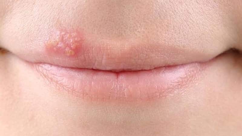 Герпес на губах: чем лечить, как быстро и эффективно вылечить простуду в домашних условиях
